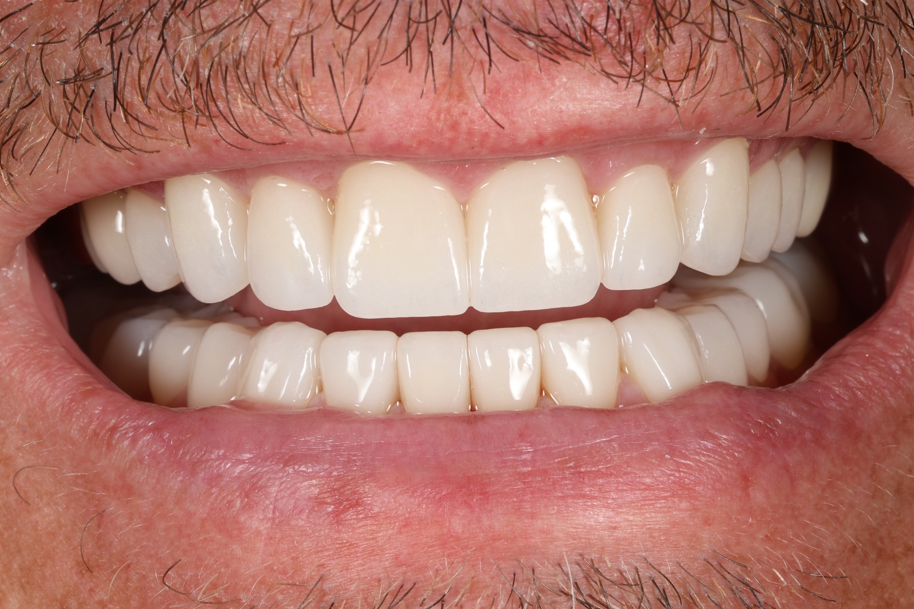 After: P.B.'s smile restored
