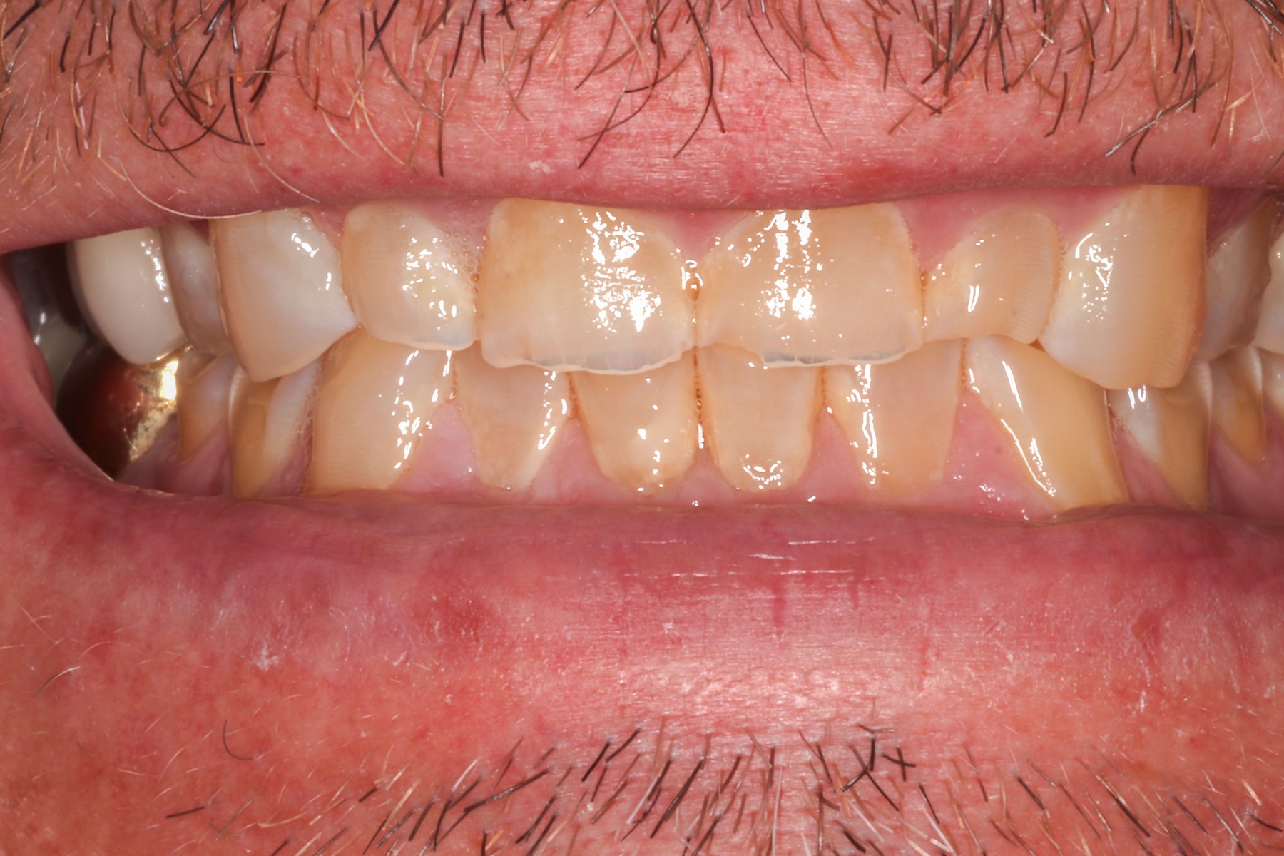 Before: P.B.'s smile
