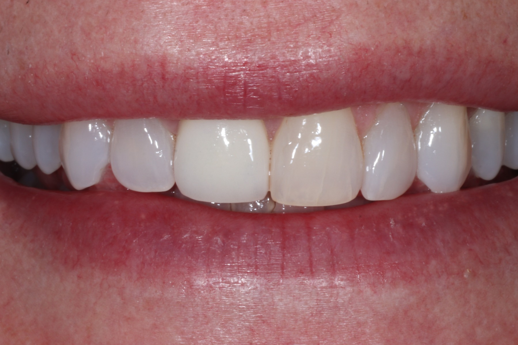 Before: P.C.'s smile