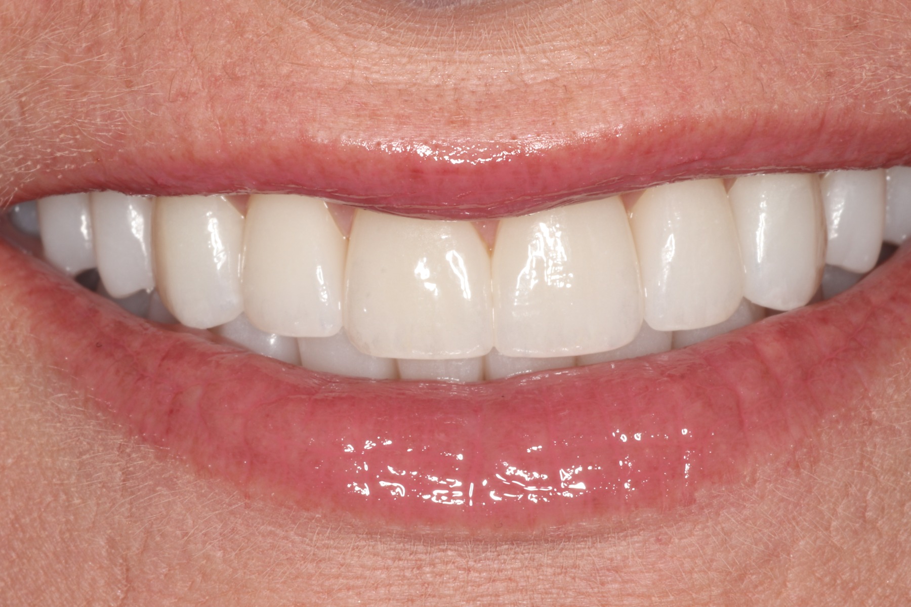 After: P.M.'s smile restored