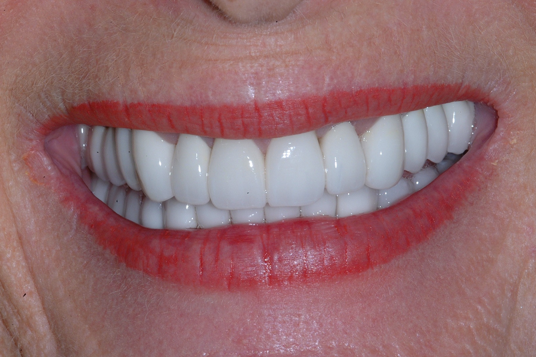 After: P.P.'s smile restored