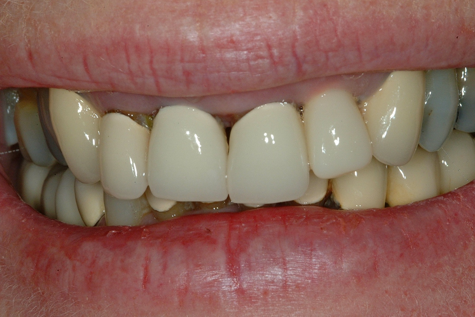 Before: P.P.'s smile