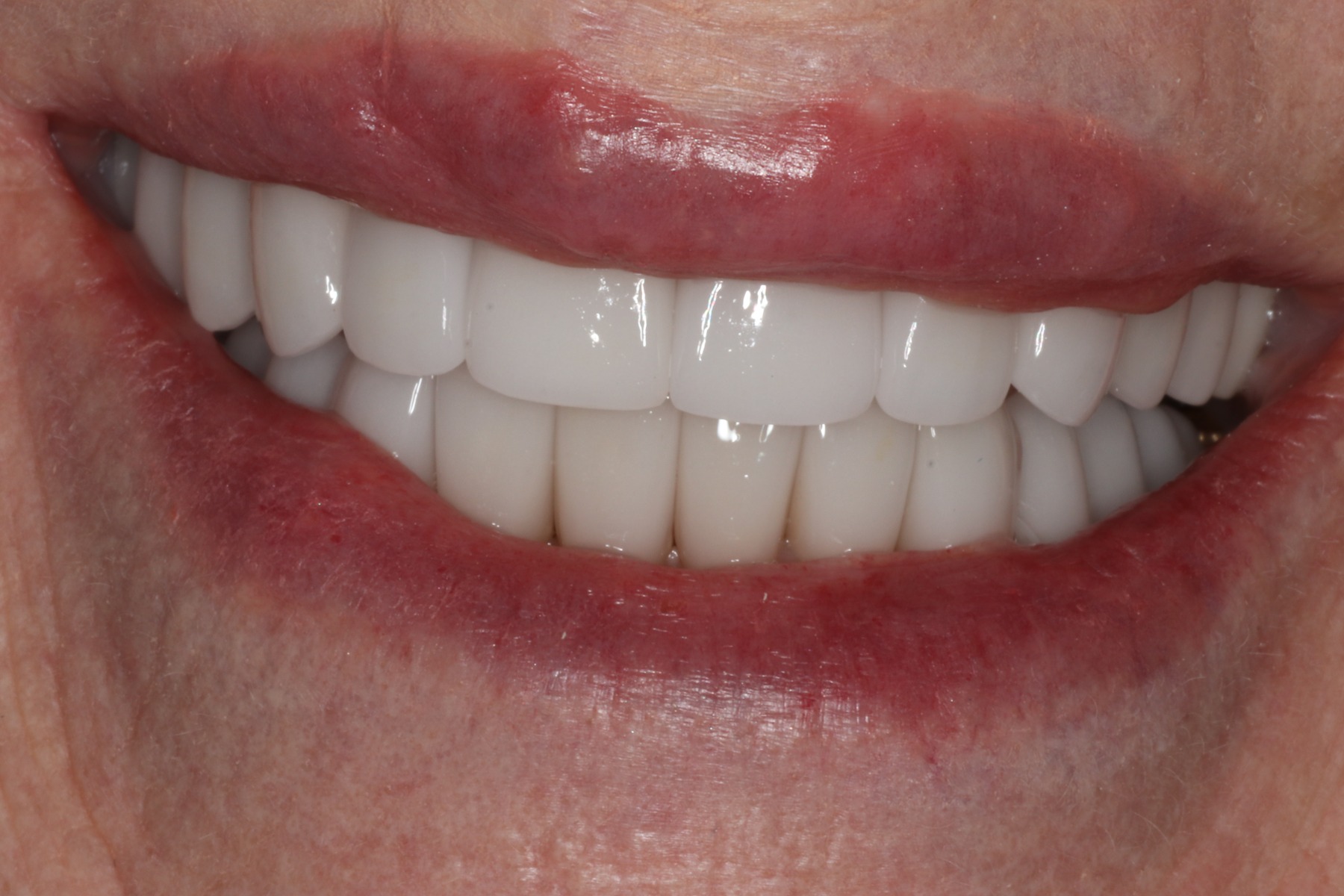 After: S.M.'s smile restored