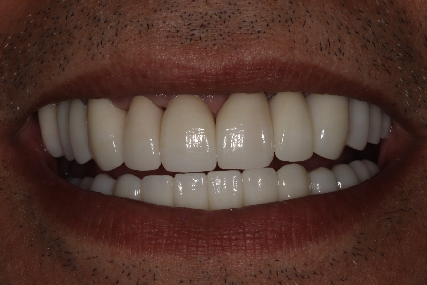 After: S.V.'s smile restored
