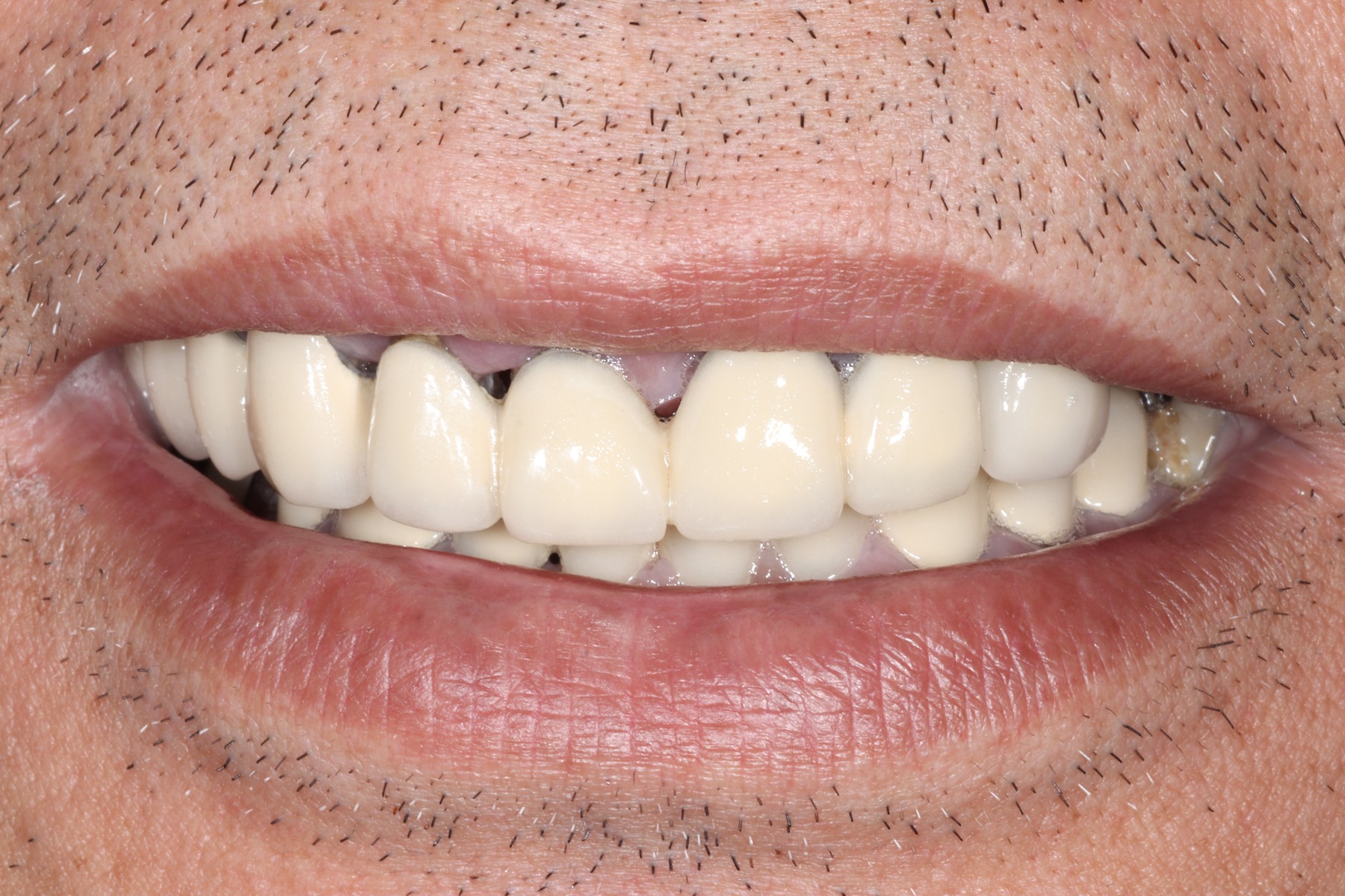 Before: S.V.'s smile