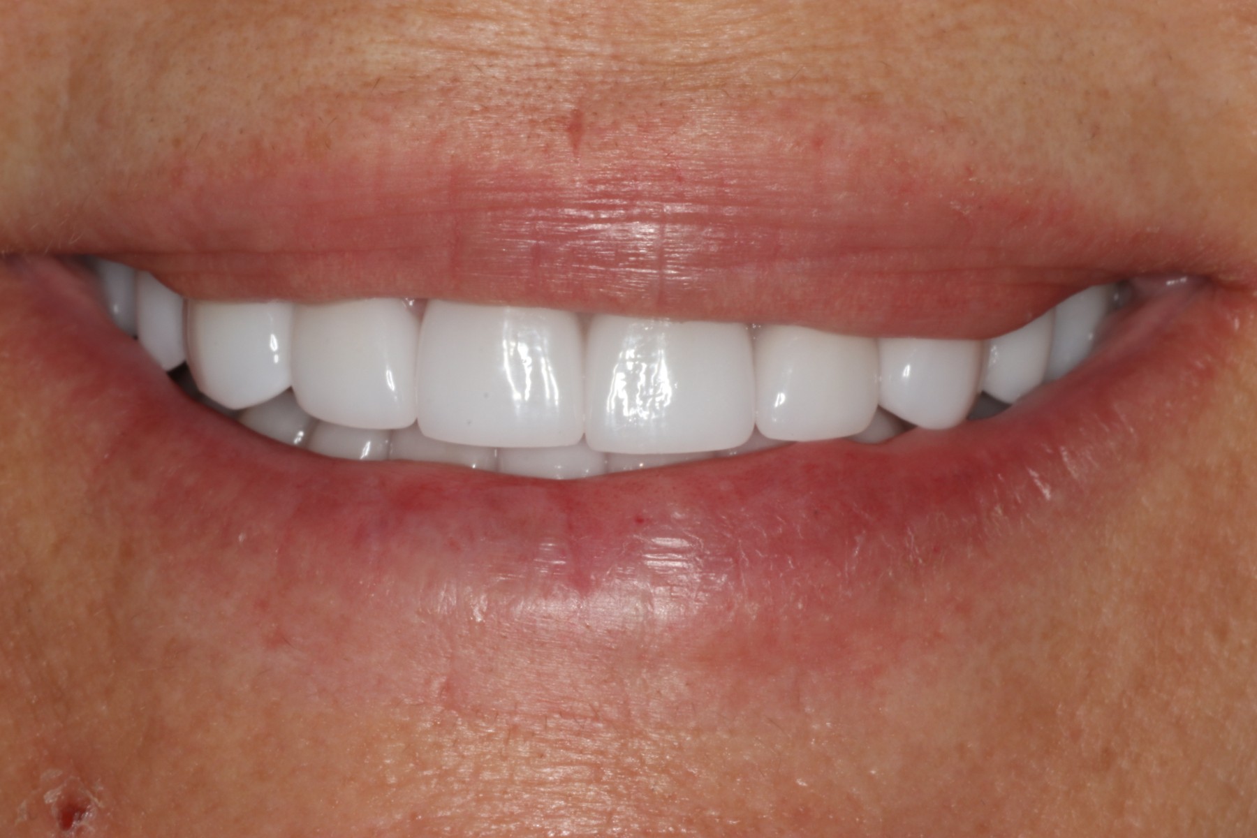 After: T.F.'s smile restored