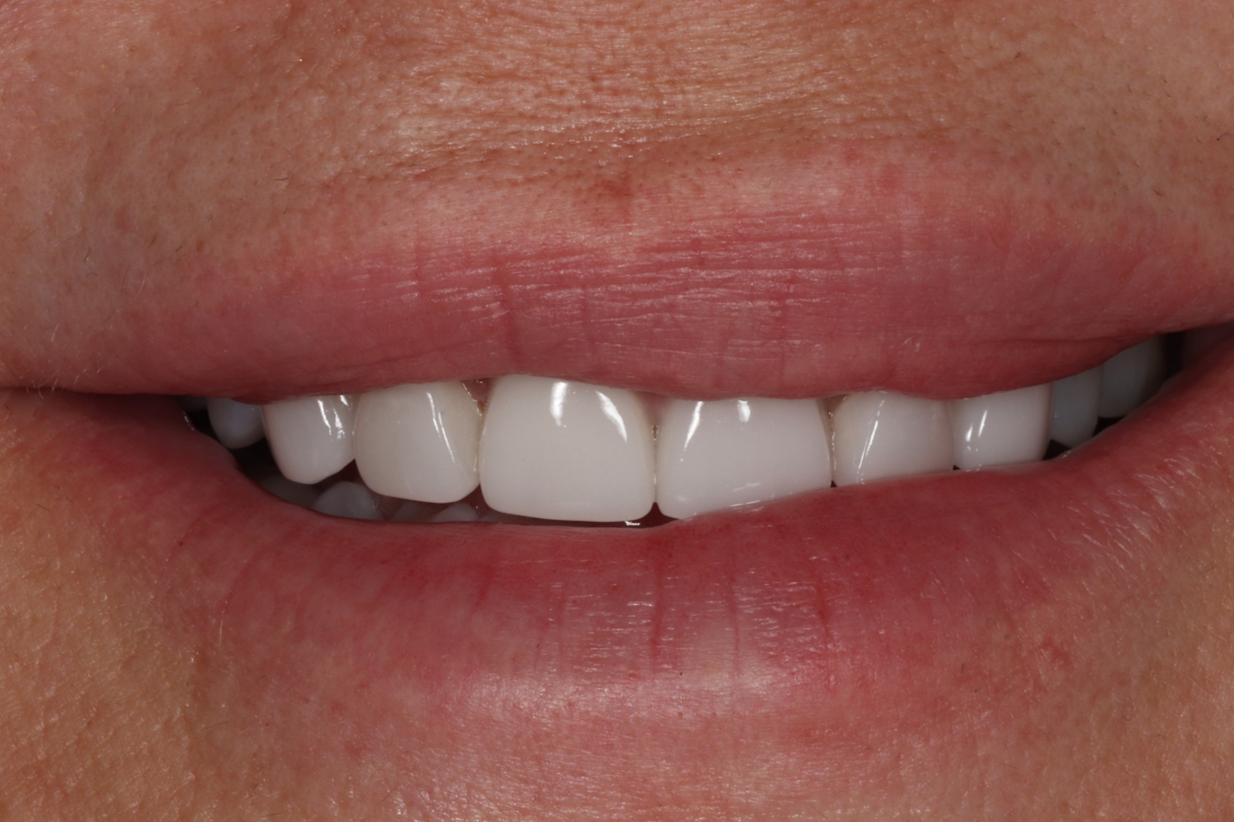 Before: T.F.'s smile