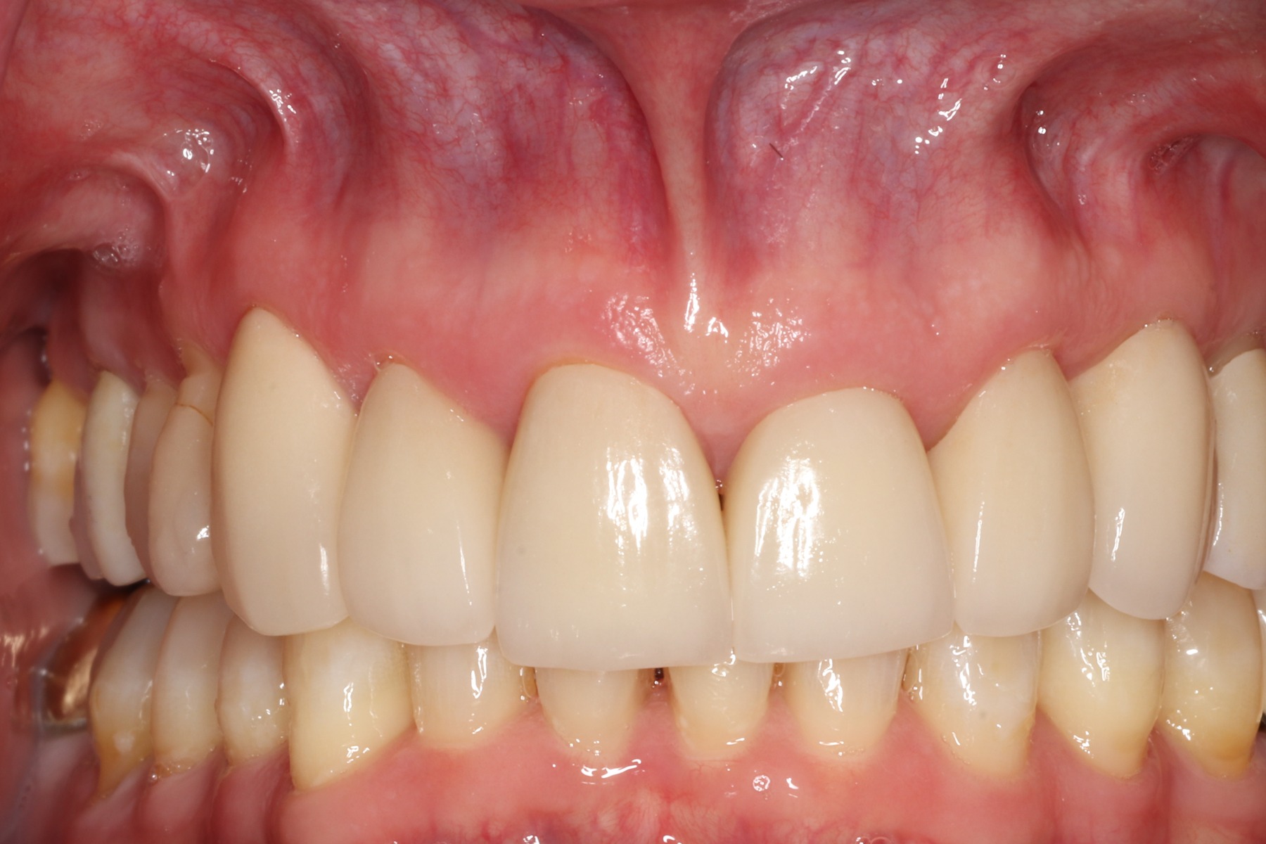 After: T.G.'s smile restored