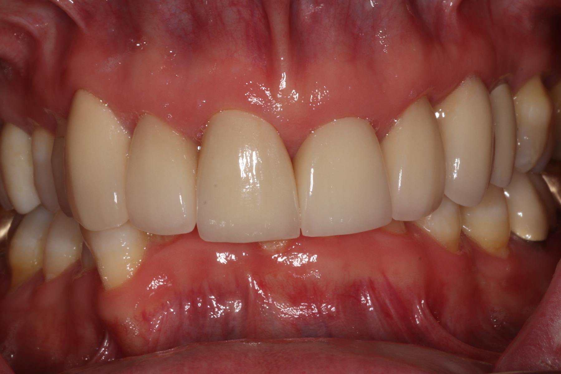 Before: T.G.'s smile