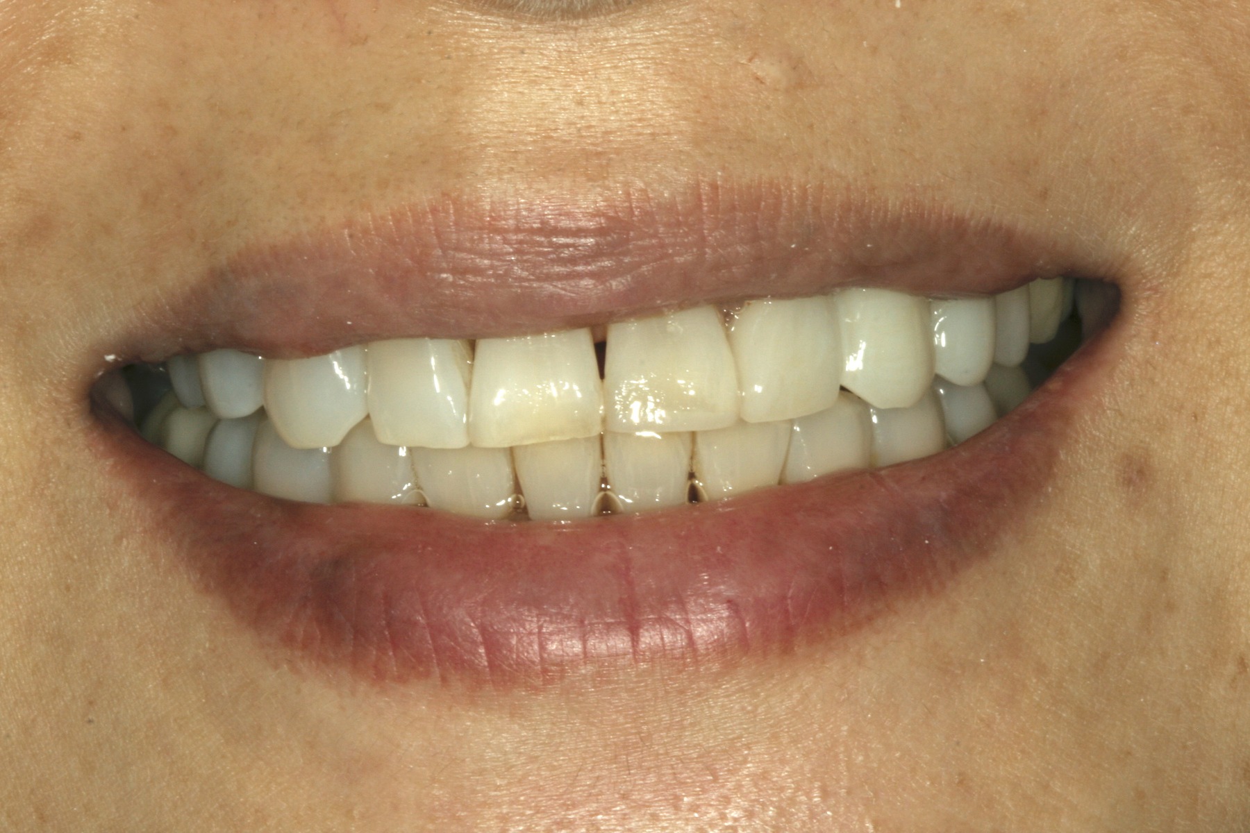 After: Y.M.'s smile restored