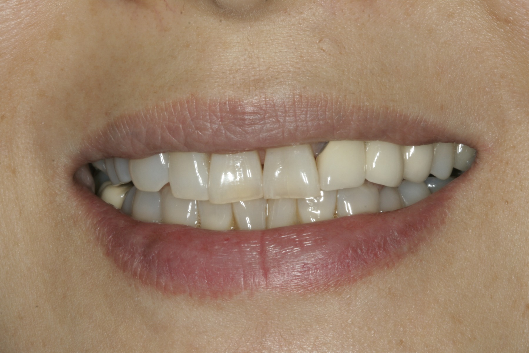 Before: Y.M.'s smile