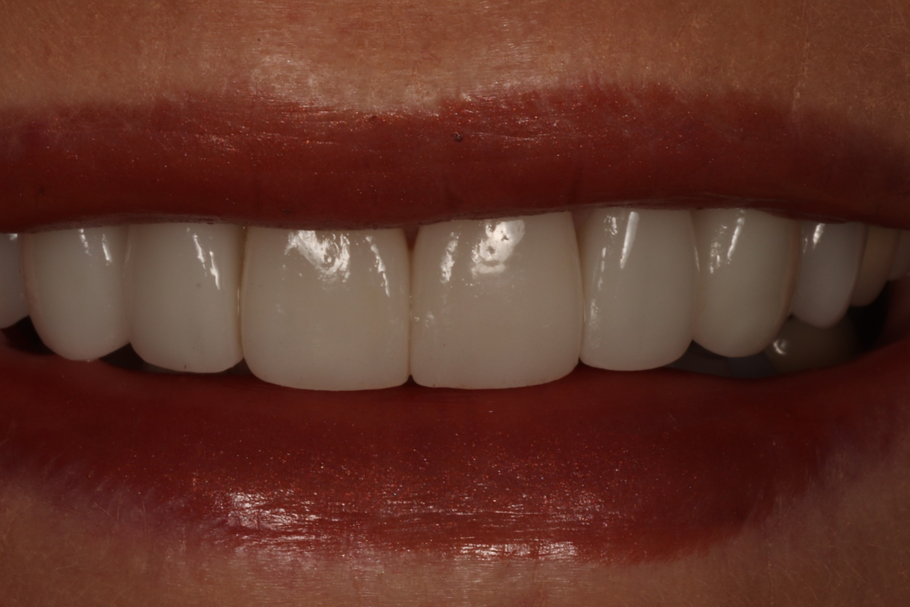 After: C.L.'s smile restored