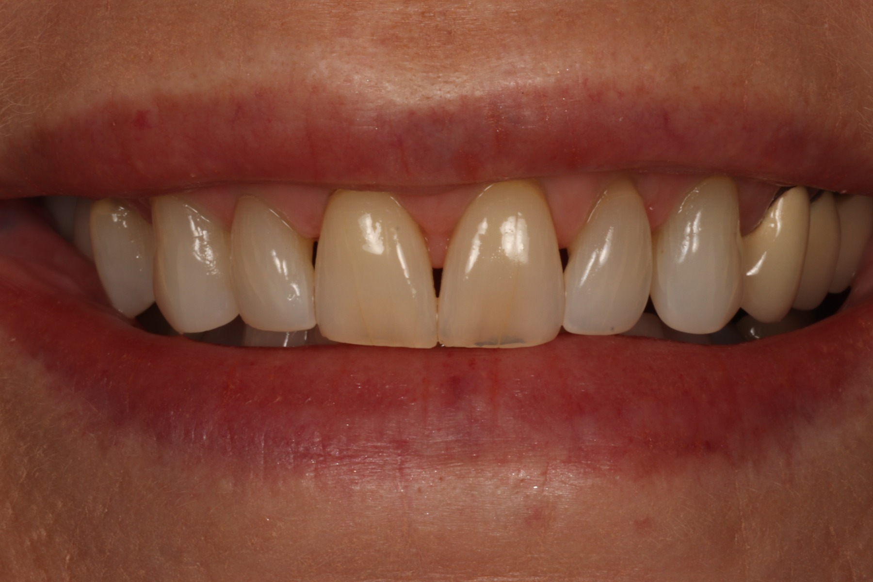 Before: C.L.'s smile