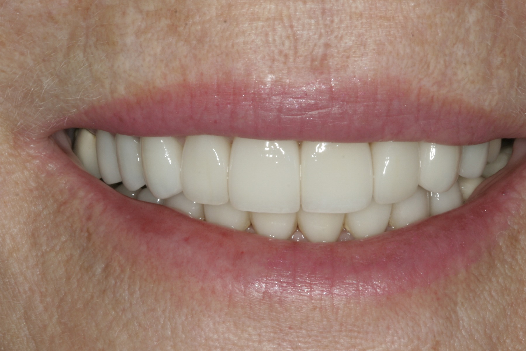 After: J.B.'s smile restored