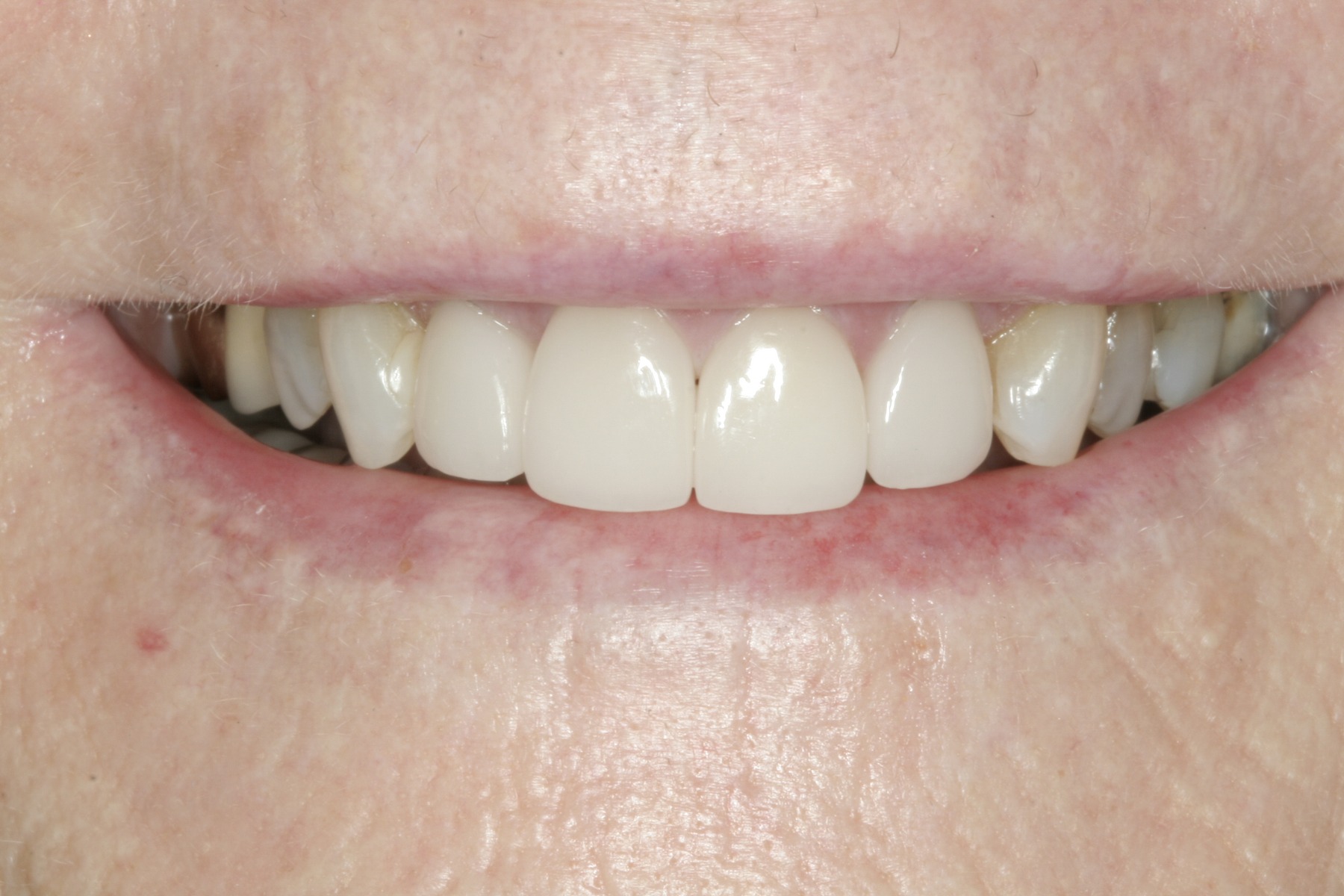 After: J.B.'s smile restored
