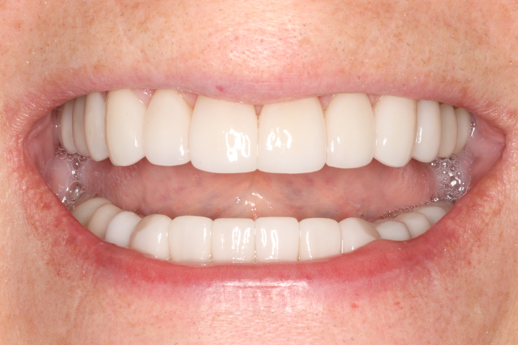 After: T.K.'s smile restored
