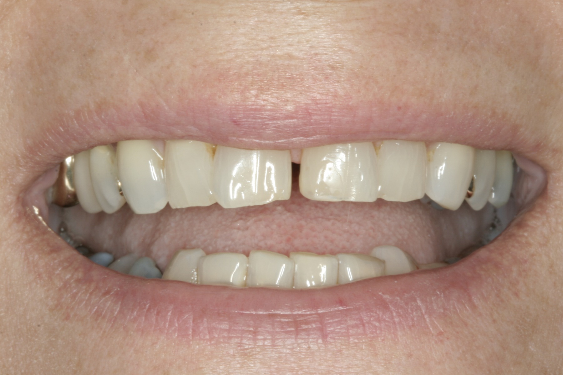 Before: T.K.'s smile
