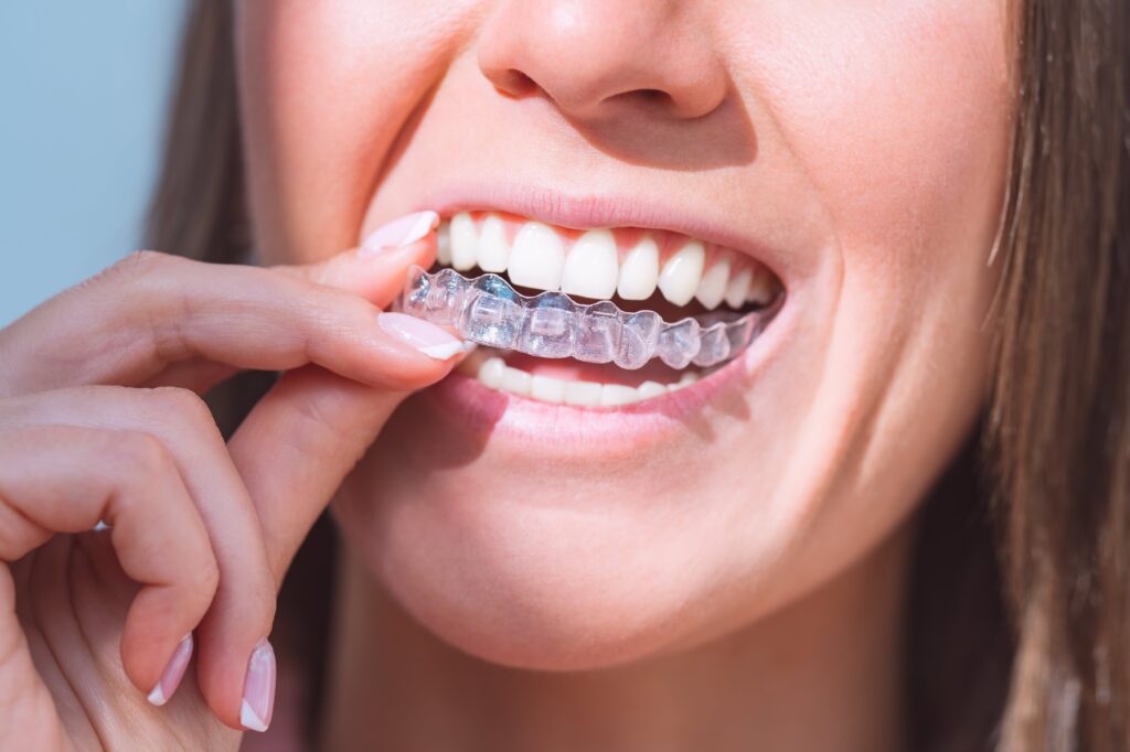 Is it Possible to Only Get Invisalign Aligners for the Bottom Teeth?