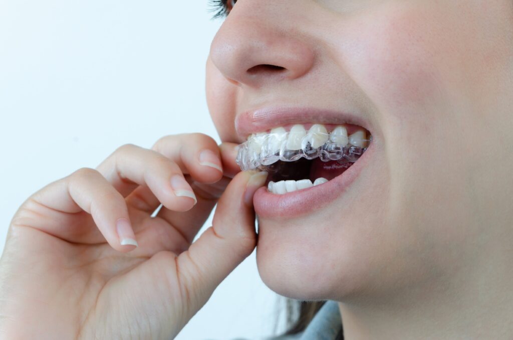 How Does Invisalign Work A Complete Guide for Las Vegas Patients