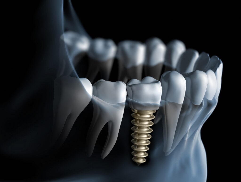 The Long-Term Influence of Dental Implants on Your Oral Health