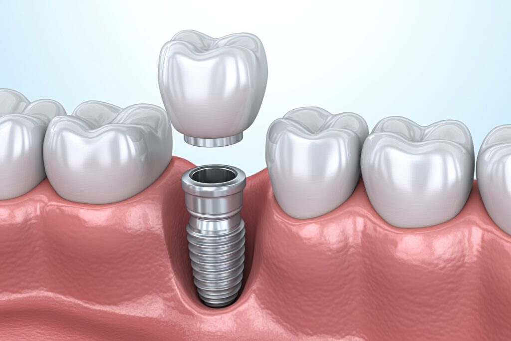 Why Dental Implants Are Worth the Investment?