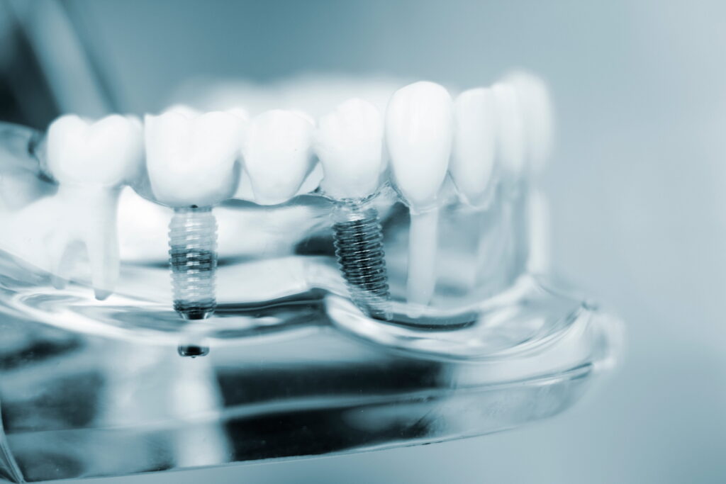 Are Dental Implants Worth It? Cost, Benefits, and What to Expect